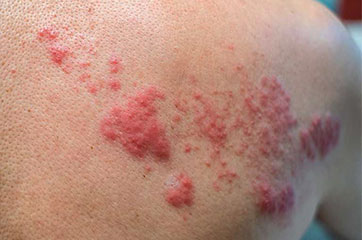 Patient needing post-shingles pain relief in Orange